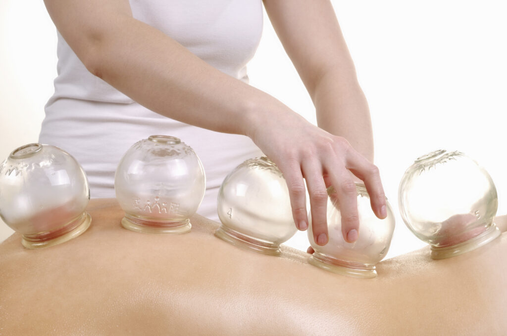 Cupping Therapy - Image related to cupping therapy.