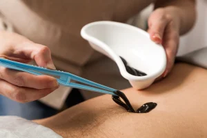 Leech Therapy and Professional Practices